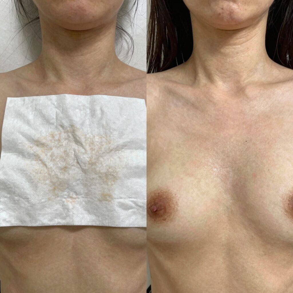데오드란트 패드 사용 전후 겨드랑이 상태 비교 사진으로 패드에 묻은 노폐물이 보임
