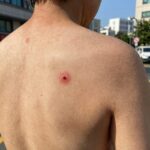 벌레 물린 자국 원인 확실한 퇴치 방법 벌레 물린 자국 사진 붉은 반점 부어오름