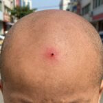 개미 물린자국 구별과 퇴치 경험 개미 물린자국으로 인한 붉은 반점과 중앙의 작은 수포가 선명하게 보이는 사진