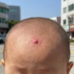 코에 생긴 헤르페스 물집의 진행 과정 사진