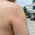 벌레에 물렸을 때 병원 방문이 필요한 붉은 핏줄과 부기 증상