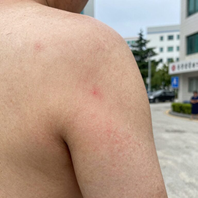 벌레에 물렸을 때 병원 방문이 필요한 붉은 핏줄과 부기 증상