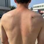 쌍살벌에 쏘인 후 부어오른 피부 사진, 벌 독에 의한 염증 반응
